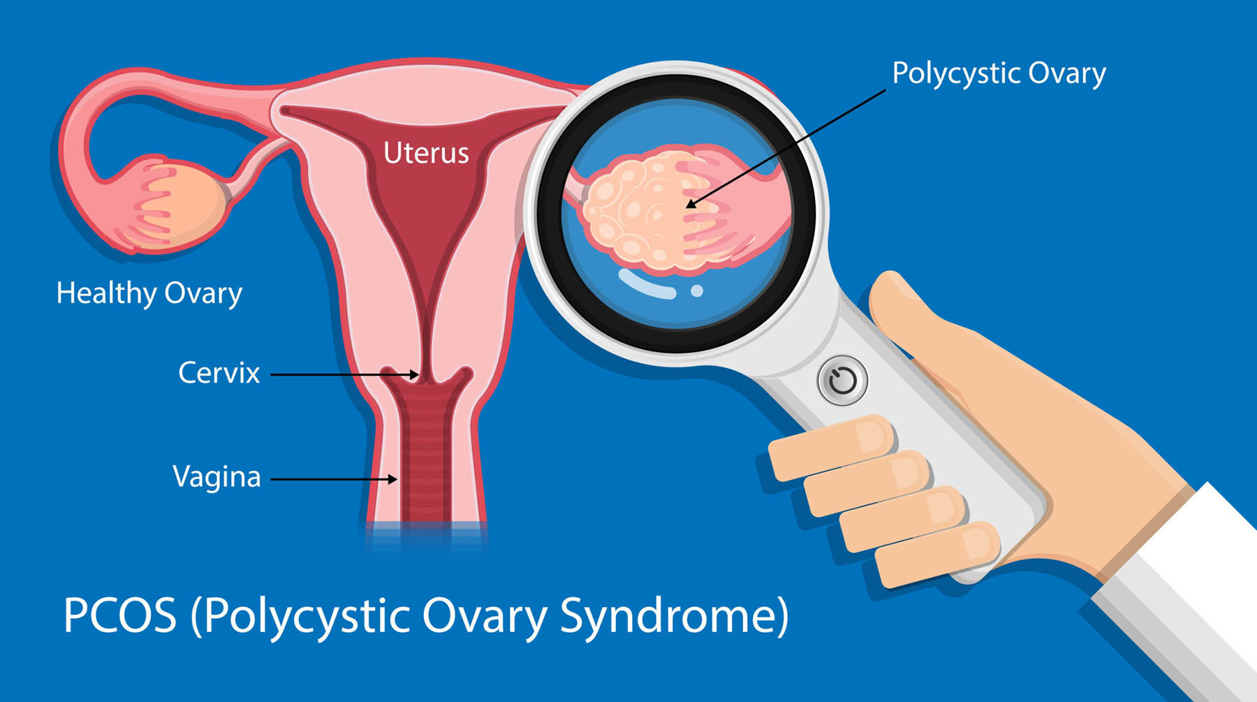 pcos2 Common symptoms of PCOS including fatigue, irregular periods, and weight gain